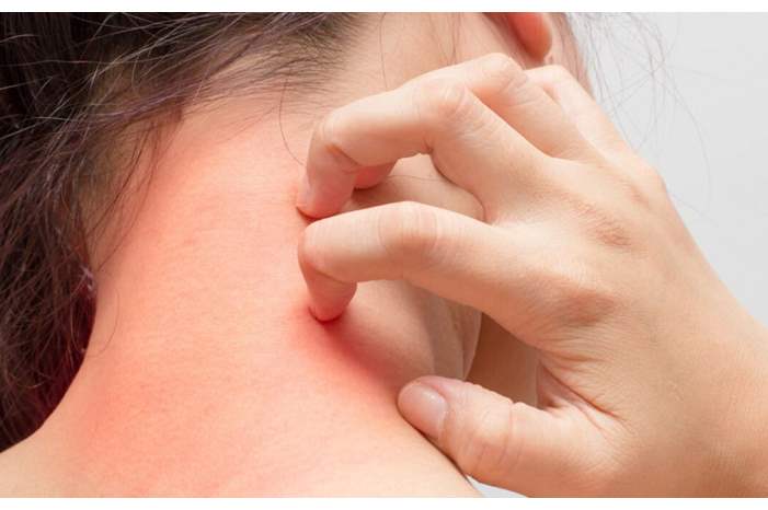 حساسية-نادرة-1300x600