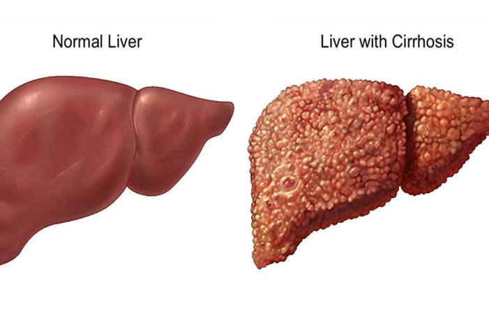 liver_cirrhosis