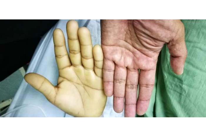 أعراض_فقر_الدم