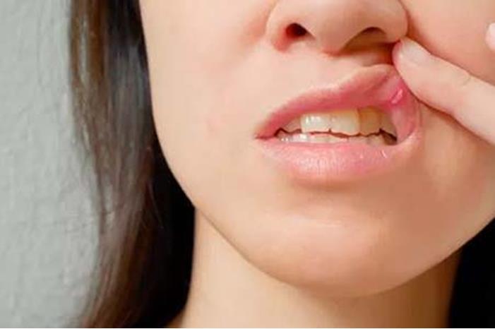 نقص فيتامين ب 12.. أربعة أعراض في الفم تحذر من انخفاض شديد الوكيل