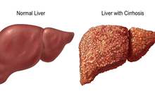 liver_cirrhosis