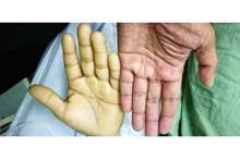 أعراض_فقر_الدم