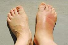 أسباب_انتفاخ_الجسم