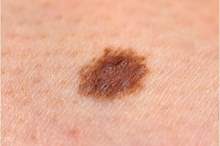 Melanoma-iStock-175217313